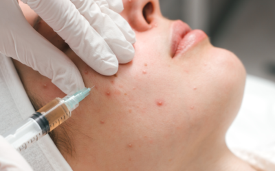 Tratamientos naturales para el acné: ¿son realmente efectivos?