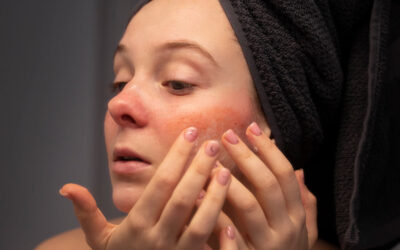 Qué es la rosácea y cómo combatir esta enfermedad de la piel