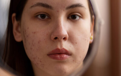 Consejos para combatir el acné y la piel grasa