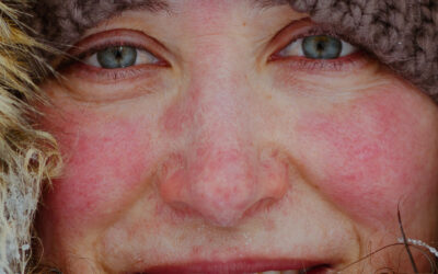 ¿Es necesario aplicar protección solar también durante el invierno?